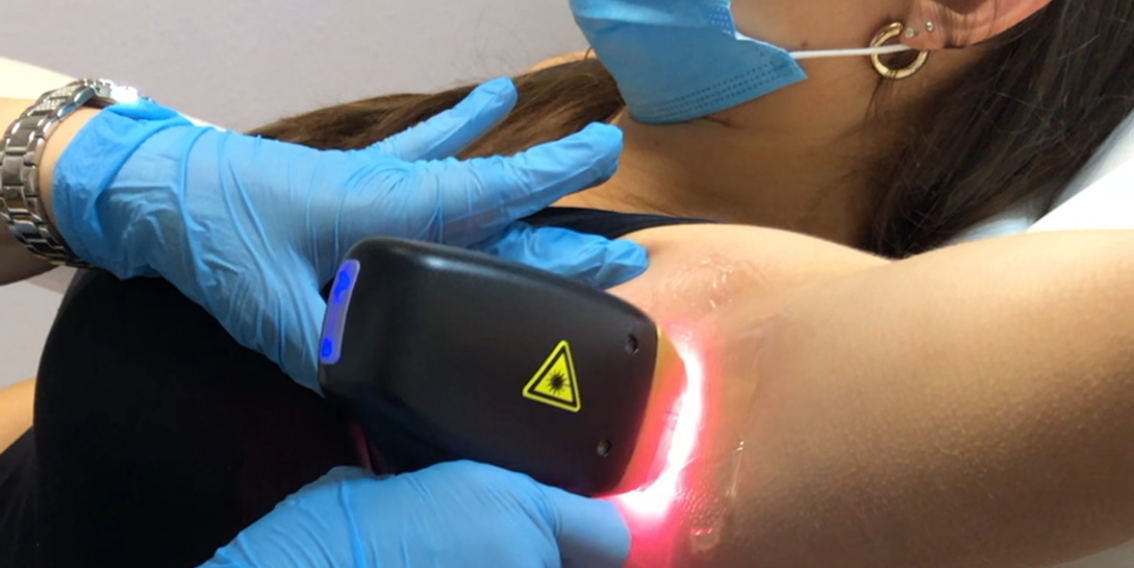 Dauerhafte Haarentfernung mit dem Dioden Laser. Reutlingen body and face Perfection